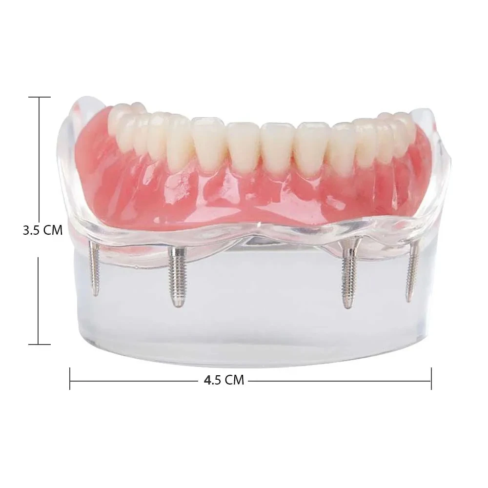 iDENTical Mandibular Overdenture Model with 4 Implants M6003